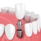 Implantes dentários