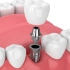 Implantes dentários