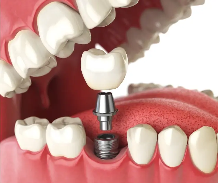 Implantes dentários