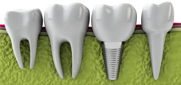 Dental implants