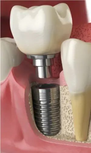 Single-tooth dental implant