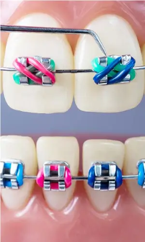 Aparelho dentário com brackets e elásticos