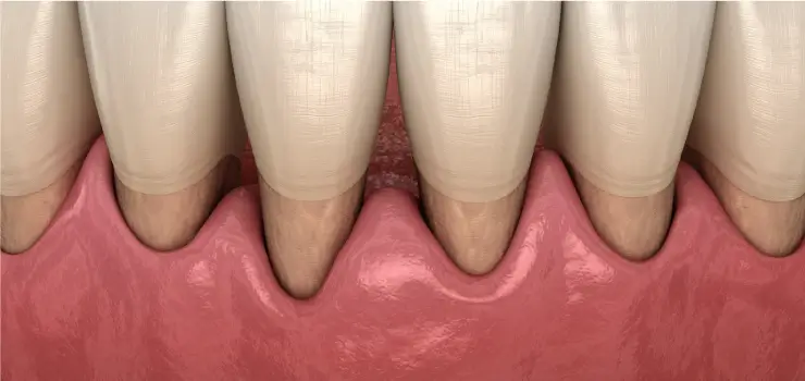 Doença periodontal