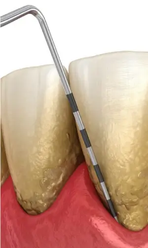 Tratamento periodontal