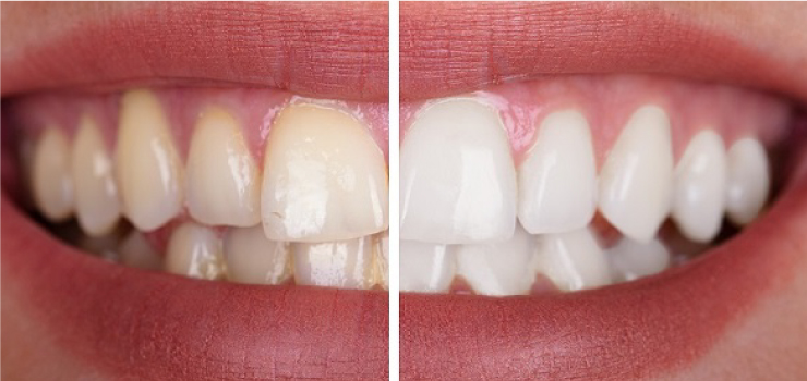Branqueamento dentário