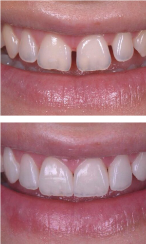 Facetas dentárias