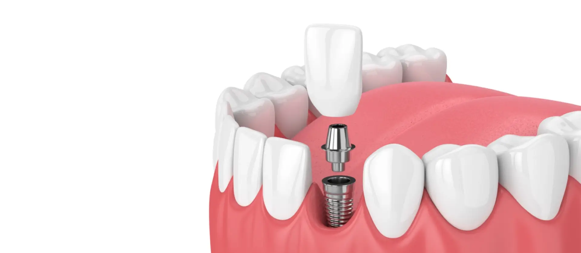 Implantes dentários